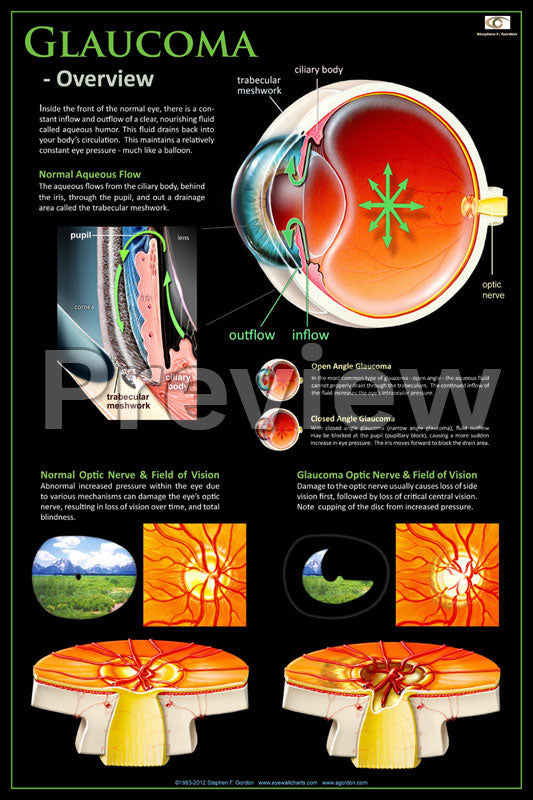 Glaucoma Overview Poster