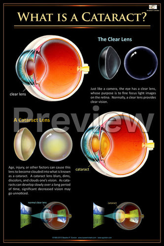 Cataract Overview Poster